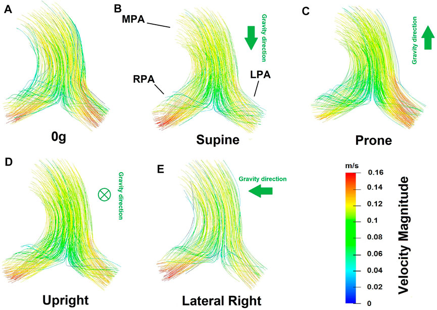 Simulating Multi-Scale Pulmonary Vascular Function by Coupling Computational Fluid Dynamics With an Anatomic Network Model